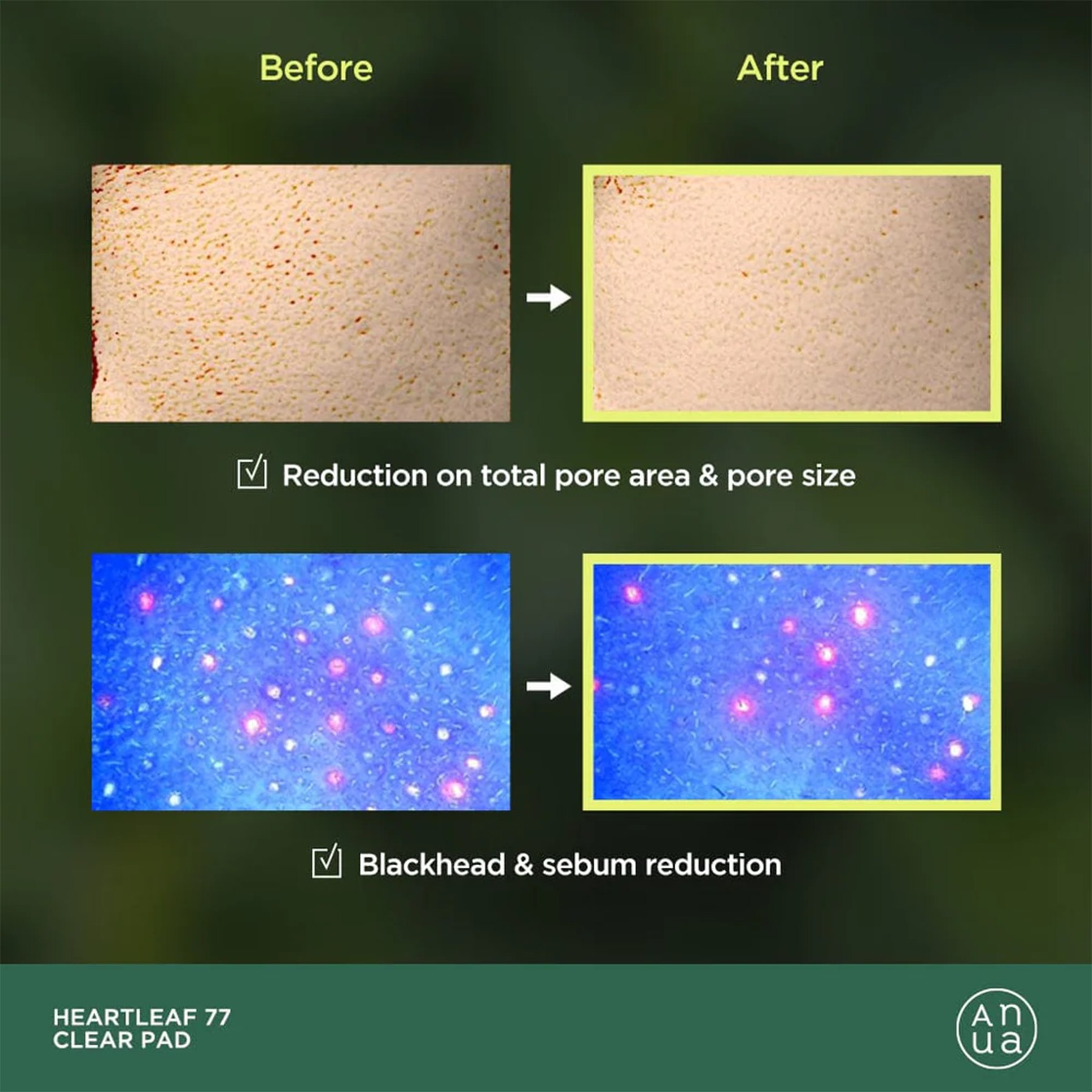 Before and After usage of Anua Heartleaf 77% Clear Pad