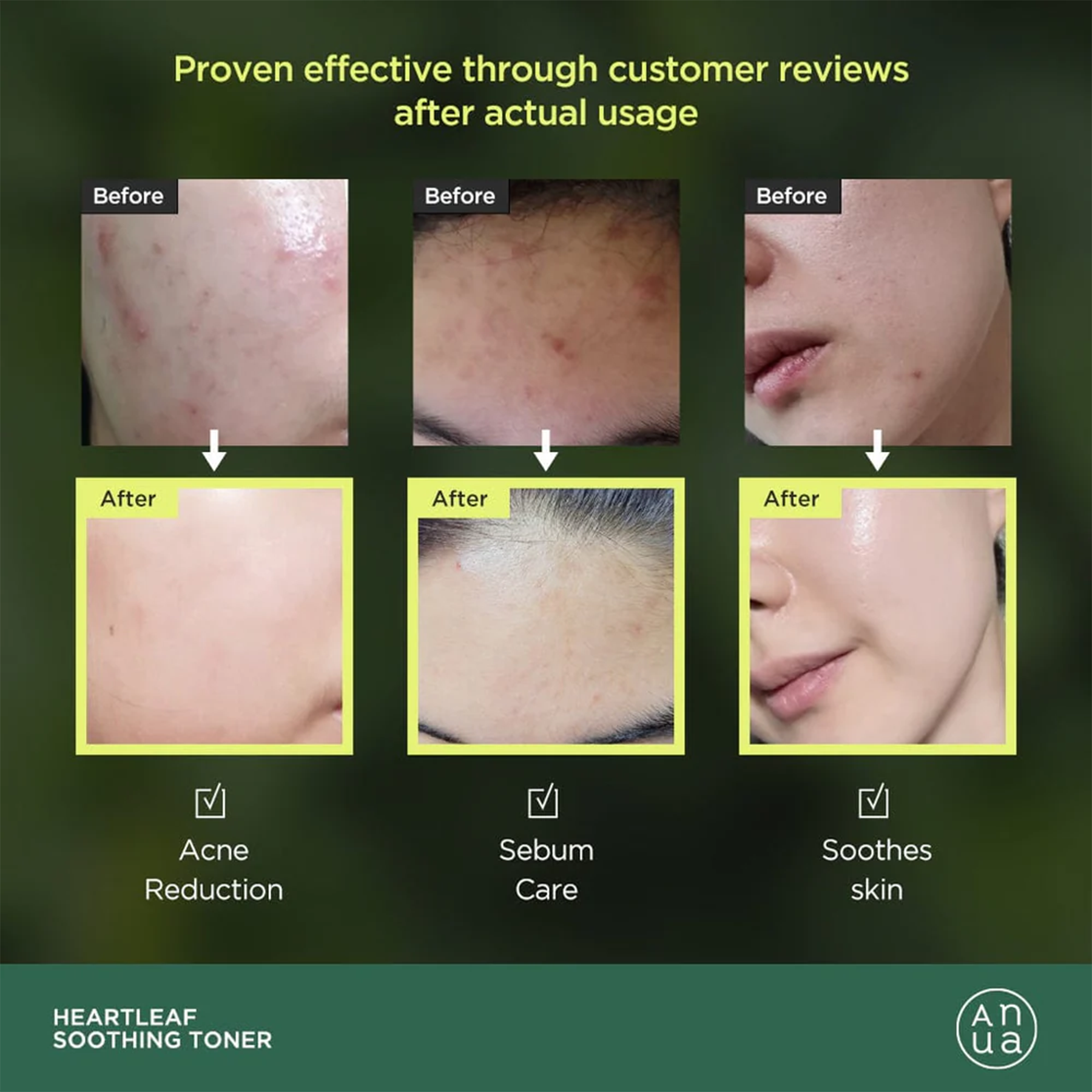 Before and after usage of Anua Heartleaf 77% Soothing Toner