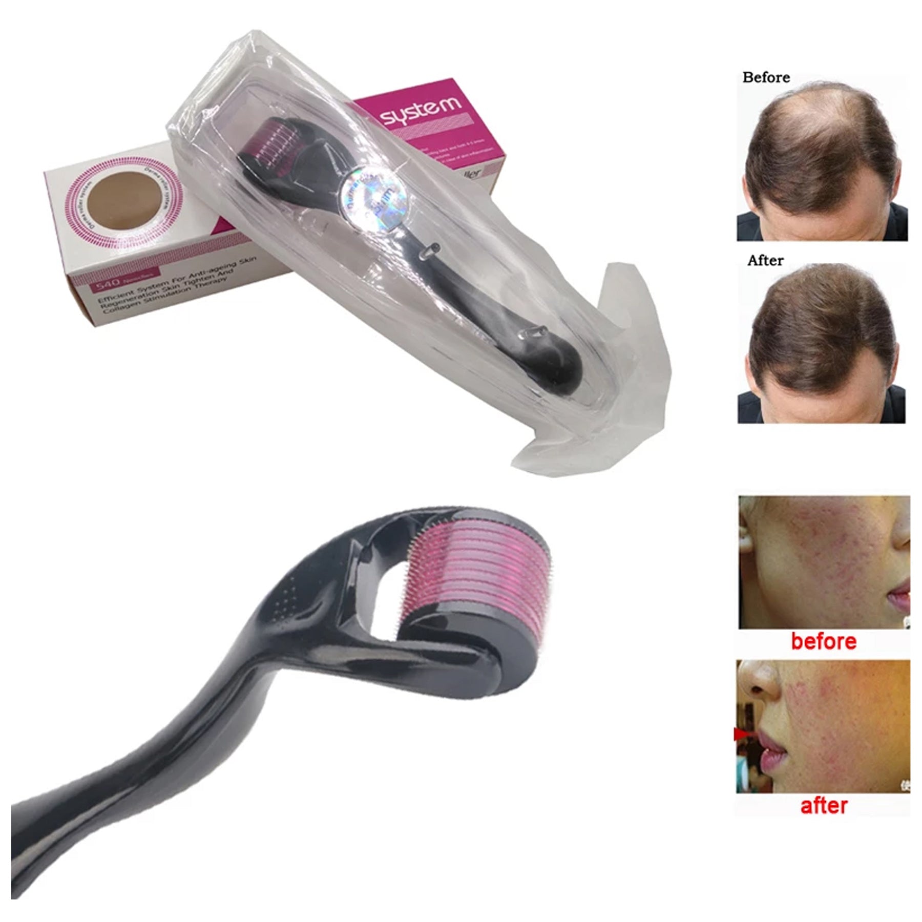 Image of the 0.5mm DRS Derma Roller with 540 titanium needles, suitable for reducing wrinkles, promoting collagen synthesis, and enhancing skincare product absorption.