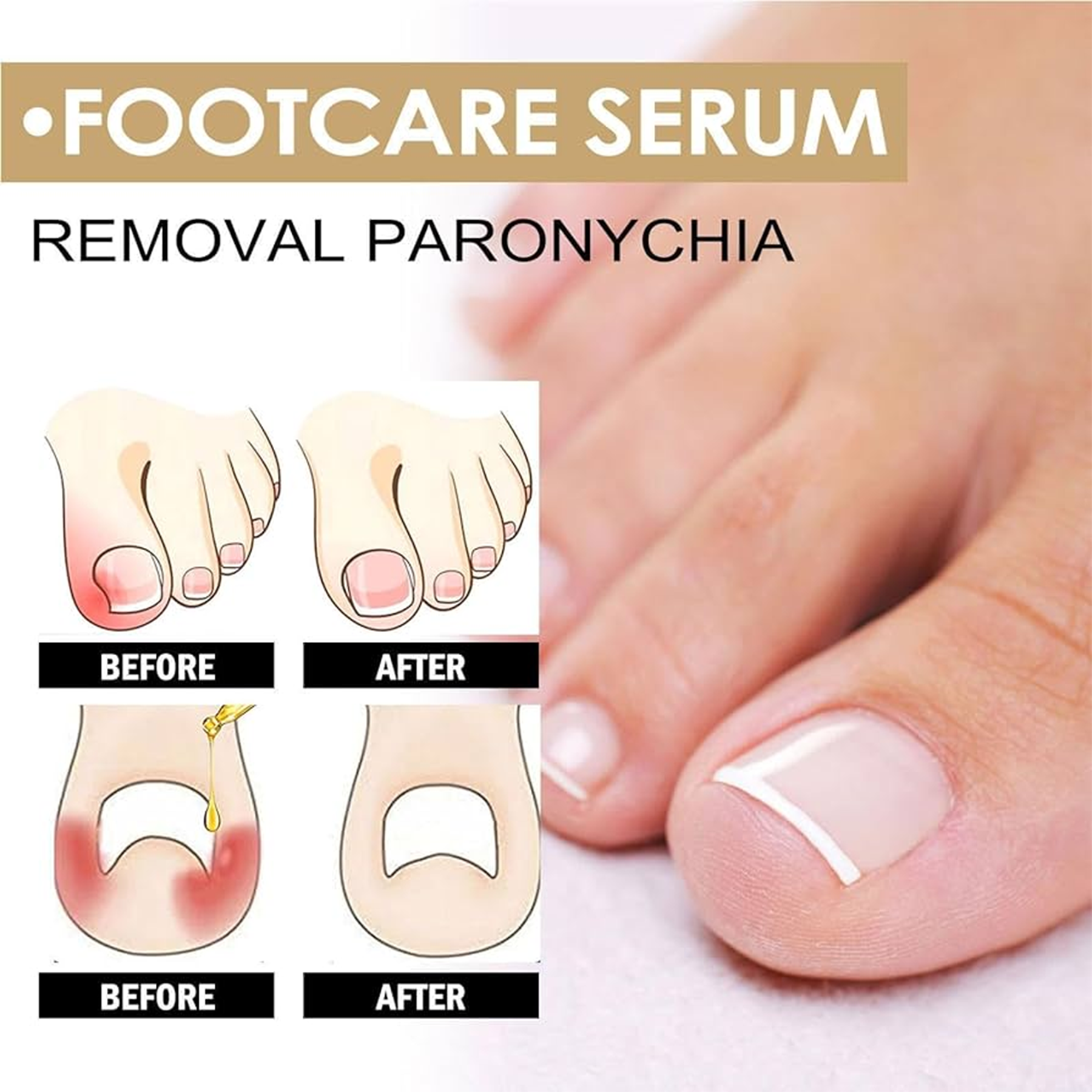 Eelhoe Footcare Serum Removal Paronychia - 73ml