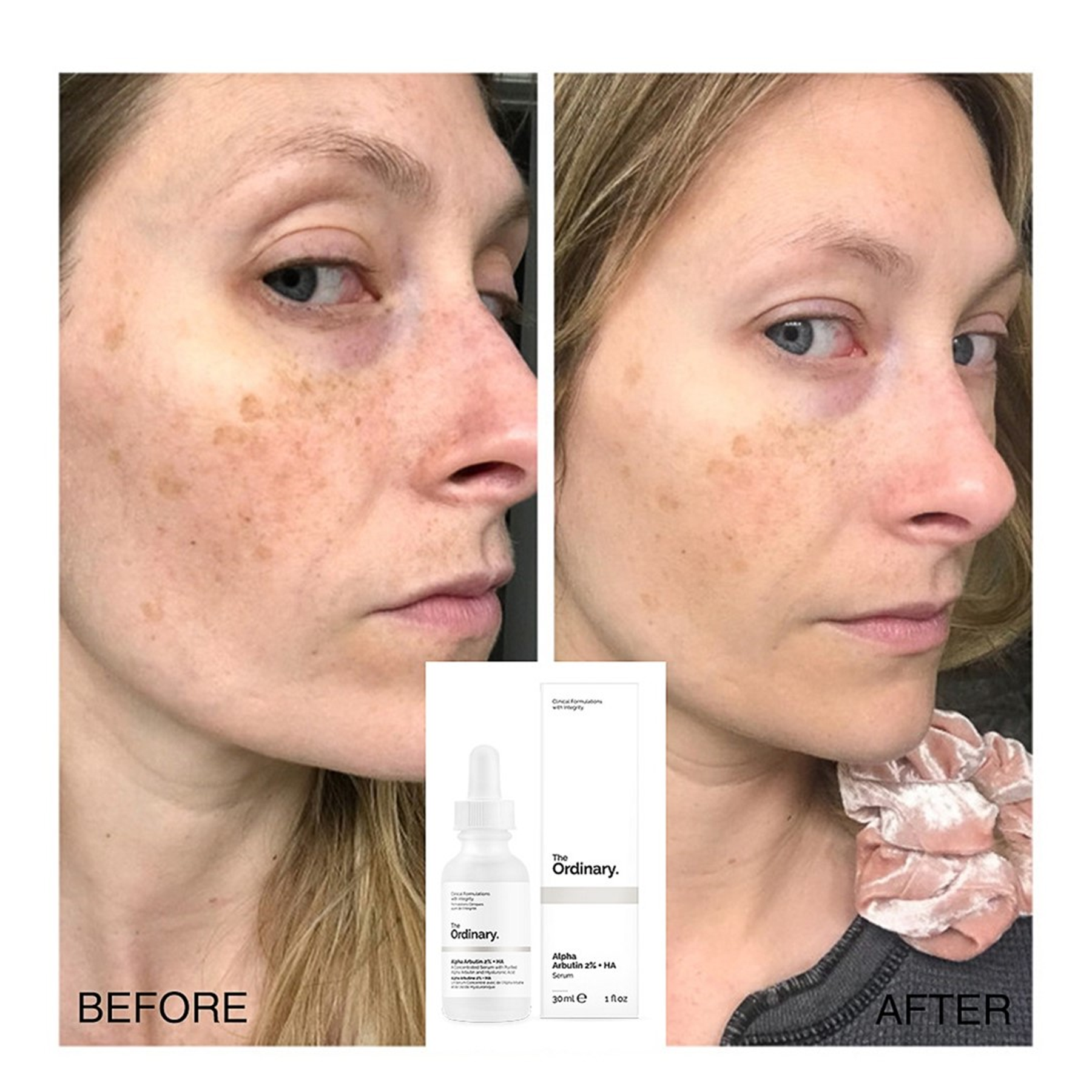 100% Original The Ordinary Alpha Arbutin Serum 2% + HA For Dark Spots & Hyperpigmentation 30ml