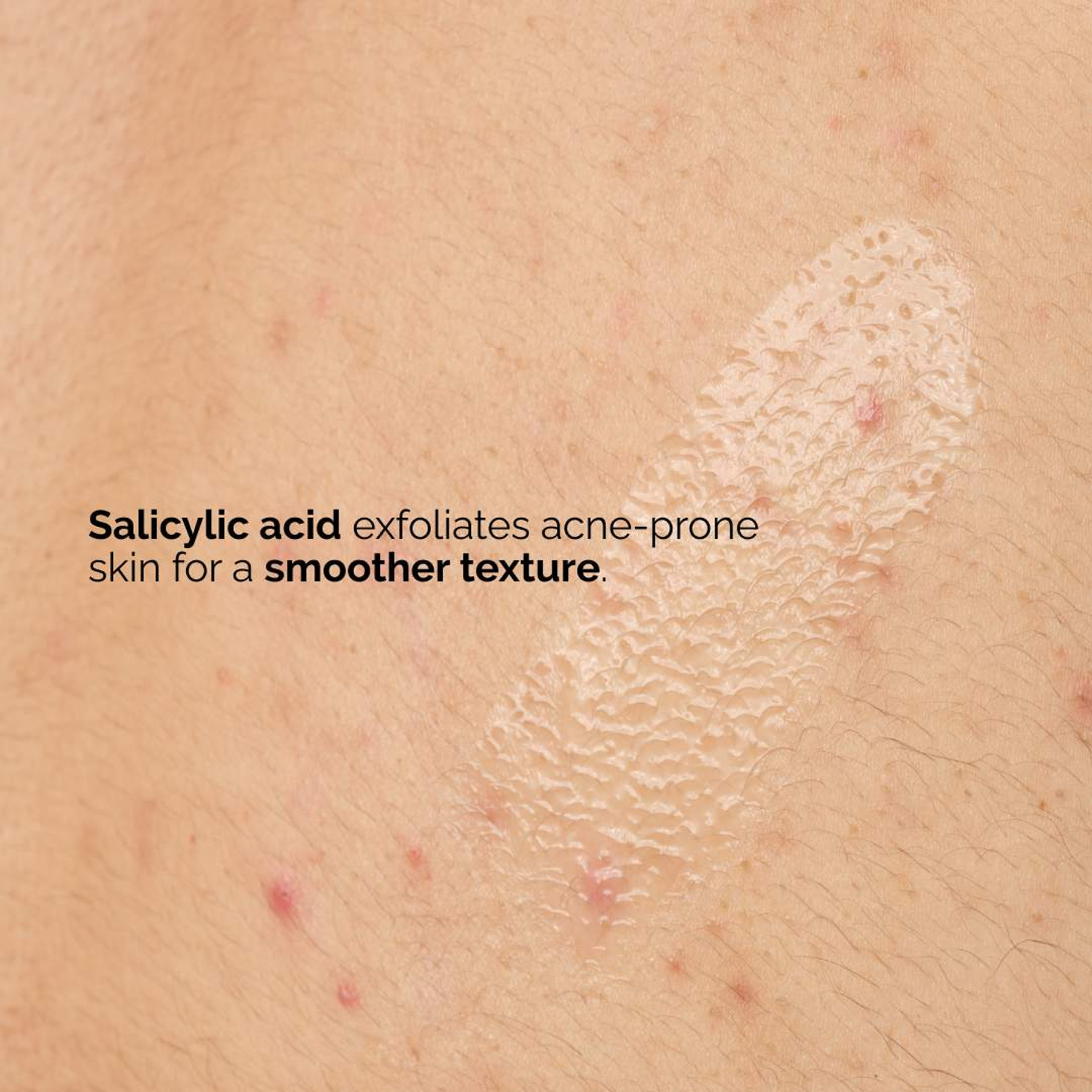 Advantages of The Ordinary Salicylic Acid 0.5% Body Serum